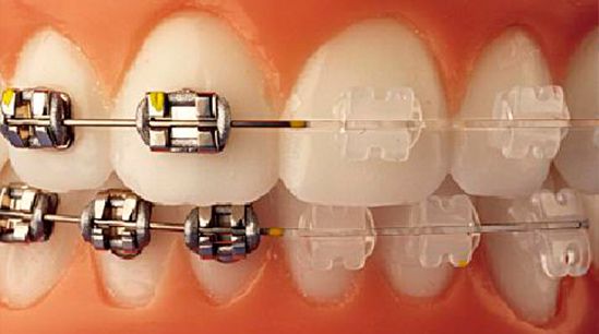 A & C Puche Clínica Dental ortodoncia invisible