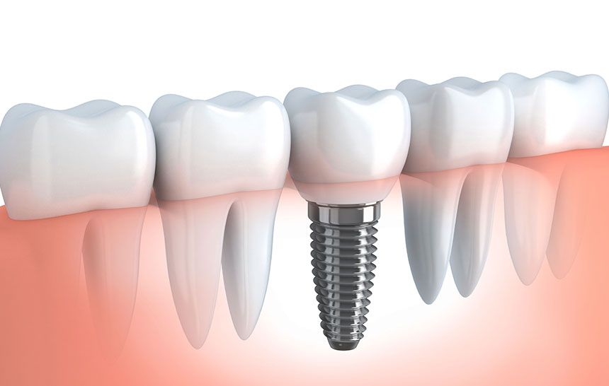 A & C Puche Clínica Dental implante dental