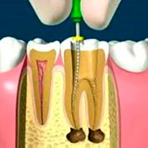 A & C Puche Clínica Dental implantes