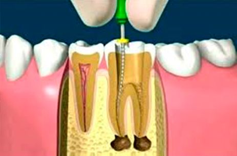 A & C Puche Clínica Dental implantes